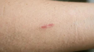 Close-up of a pink-red scar on a woman’s skin in soft daylight