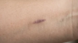 Close-up of a scar with a muted purple tone on a woman’s forearm
