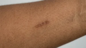 Close-up of a brown-toned scar on a woman’s forearm, darker than the surrounding skin.