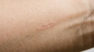 Close-up of a faint pink-beige scar on a woman’s forearm in soft daylight