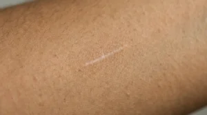 Close-up of a pale scar that is lighter than the surrounding skin on a woman’s forearm.