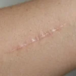 Close-up of a subtle pink-beige scar on a woman’s forearm in soft daylight.