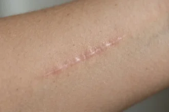 Close-up of a subtle pink-beige scar on a woman’s forearm in soft daylight.