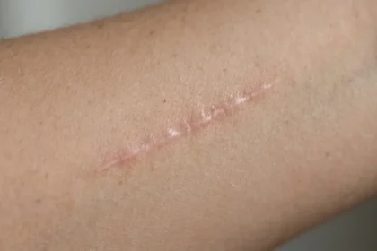 Close-up of a subtle pink-beige scar on a woman’s forearm in soft daylight.
