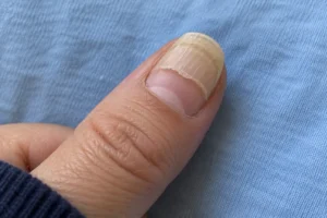 Close-up illustration of a thumbnail with an older nail segment and smooth pink growth near the base.