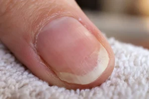 Close-up illustration of a fingernail with a pale white area near the lifted tip.