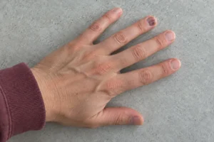 Hand with a clearly visible dark brown-purple bruise beneath the middle fingernail.