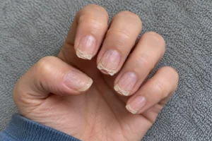 Close-up of unpolished fingernails with peeling layers and split tips against a gray towel.