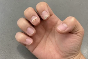 Hand with all five fingers visible, showing a split nail layer and an irregular white area on a neighbouring nail.