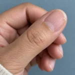 Close-up of an unpolished thumbnail with lengthwise ridges and a small peeling layer near the tip.
