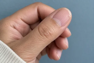 Close-up of an unpolished thumbnail with lengthwise ridges and a small peeling layer near the tip.