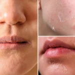 Three close-up views of dry, flaky facial skin around the nose, cheeks, mouth, and chin.
